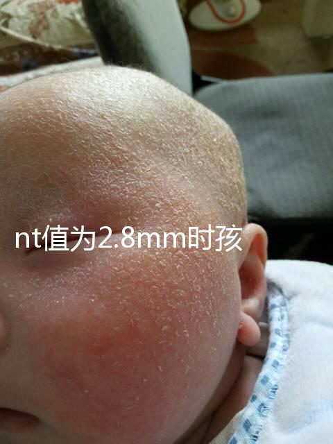 nt值為2.8mm時(shí)孩子也能要，正常與否還要進(jìn)一步檢查